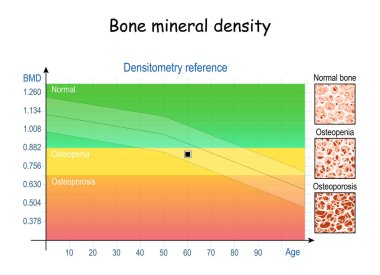 Kemik mineral yoğunluğu (BMD). Densitometri referansı (grafik). Kemik dokusunun Osteoporoz ve Osteoporoz 'a yakın durumdaki hali. Yaşlanma süreci. vektör illüstrasyonu