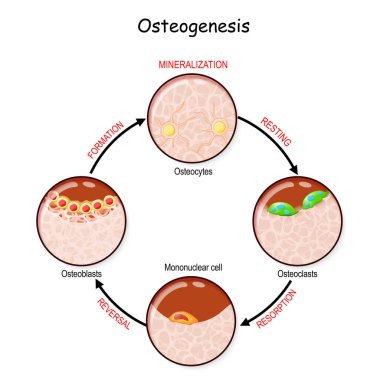 bone remodeling (resting, resorption, reversal, mineralization, formation). Describe a process of Ossification. osteogenesis. Bone is broken down by osteoclasts, and rebuilt by osteoblasts clipart