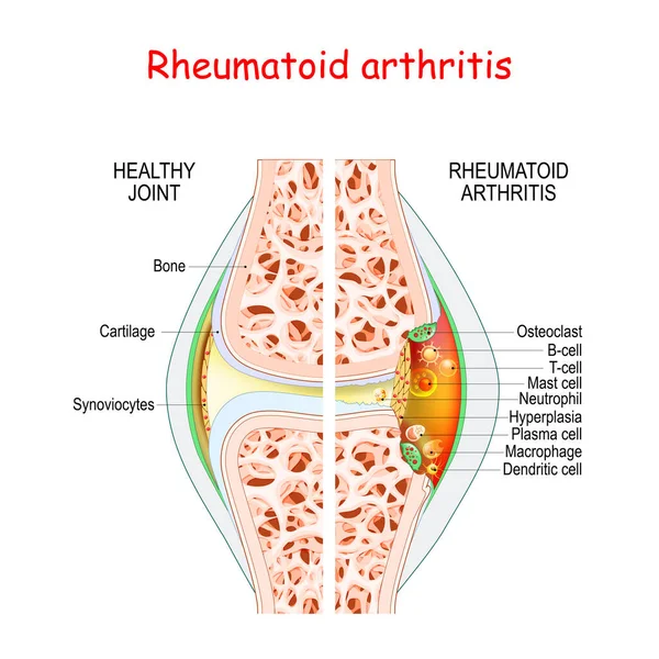Rheumatoid arthritis. Healthy and damage joint. Close-up of bone, cartilage, and Cells in a joint capsule: synoviocytes, osteoclast, neutrophil, T lymphocyte, B-cell, macrophage, mast, plasma, and dendritic cell, — Stock Illustration Rheumatoid Arthritis Healthy Damage Joint Close Bone Cartilage Cells Joint Stock Vector