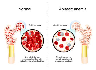 Aplastik anemi. Uyluk kemiğinde kemik iliği yetmezliği olan bir kesit. Kan hücrelerine yakın çekim. Kemik iliğindeki kök hücreler kırmızı kan hücreleri, beyaz kan hücreleri ve trombositler üretir. vektör illüstrasyonu