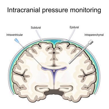 Kafatası içi basınç. ICP izleme. İnsan beyninin çapraz kesiti. Basınç sondalarının ya da sondaların yerelleştirilmesi. Epidural, subdural, parankimal, ventriküler. Travmada cerrahi teknikler. vektör illüstrasyonu