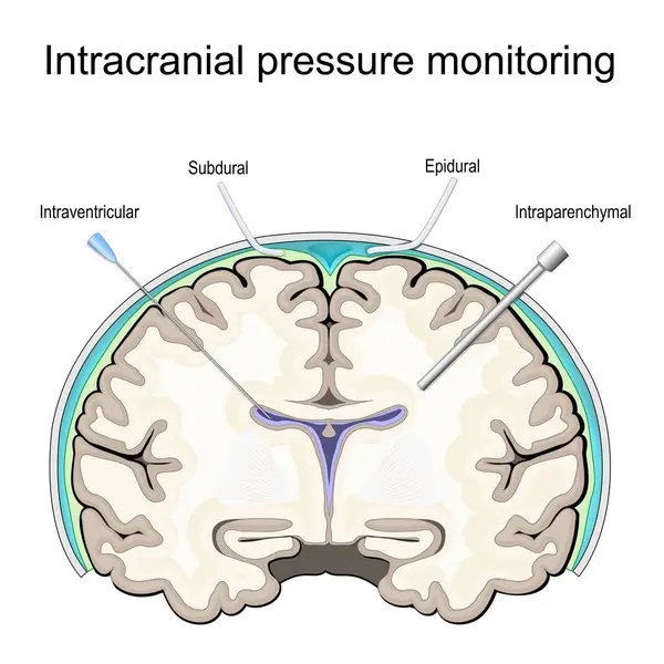 Koponyaűri Nyomás Icp Ellenőrzés Egy Emberi Agy Keresztmetszete Nyomásszondák Vagy Stock Vektor