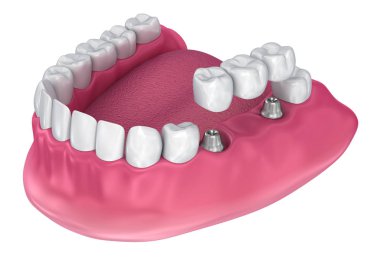 Desteklenen sabit köprü implant. Tıbben doğru 3d çizim