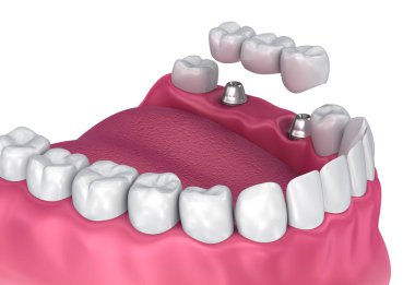 Desteklenen sabit köprü implant. Tıbben doğru 3d çizim