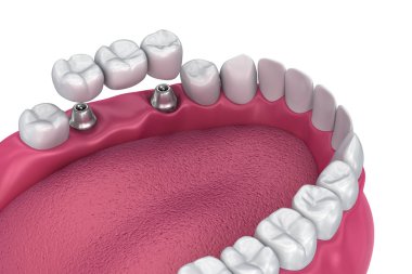 Desteklenen sabit köprü implant. Tıbben doğru 3d çizim