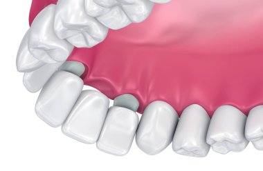 Desteklenen sabit köprü diş. Tıbben doğru 3d çizim