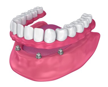 Overdenture implant - top ekleri oturmak için. 3D çizim
