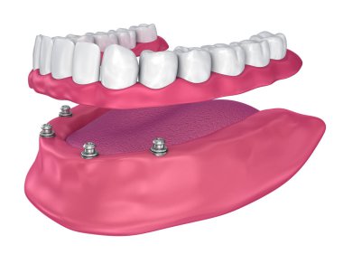 Overdenture implant - top ekleri oturmak için. 3D çizim