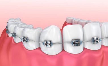 Diş telleri üzerinde beyaz izole dişli. Tıbben doğru 3d çizim 
