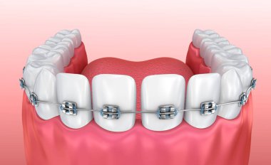 Diş telleri üzerinde beyaz izole dişli. Tıbben doğru 3d çizim 