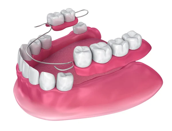 Dentiera Parziale Rimovibile Illustrazione Clinicamente Accurata — Foto Stock