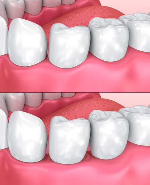 Gomme Normale Abaissée Illustration Dentaire Médicalement Précise — Photo