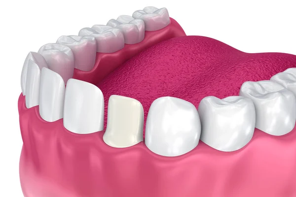 Chapas Dentales Procedimiento Instalación Chapa Porcelana Ilustración — Foto de Stock
