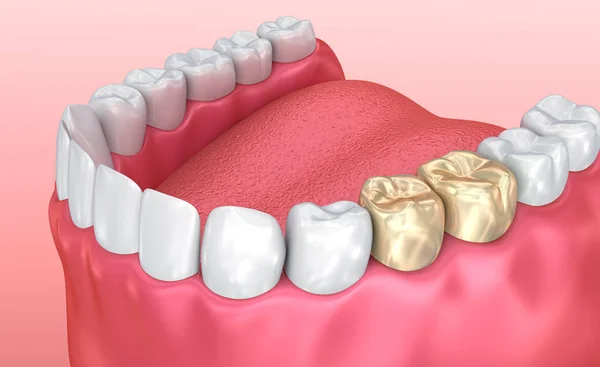 Здоровые Зубы Золотые Коронки Медицинская Точность Иллюстрации Зубов — стоковое фото