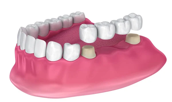 牙支承固定桥 医学上精确的3D — 图库照片