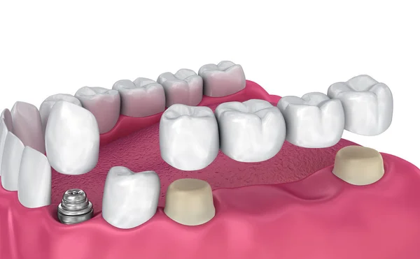 Tooth supported fixed bridge, implant and crown. Medically accurate 3D illustration