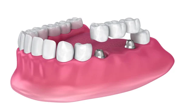 Implant Supported Fixed Bridge Medically Accurate Illustration — Stock Photo, Image