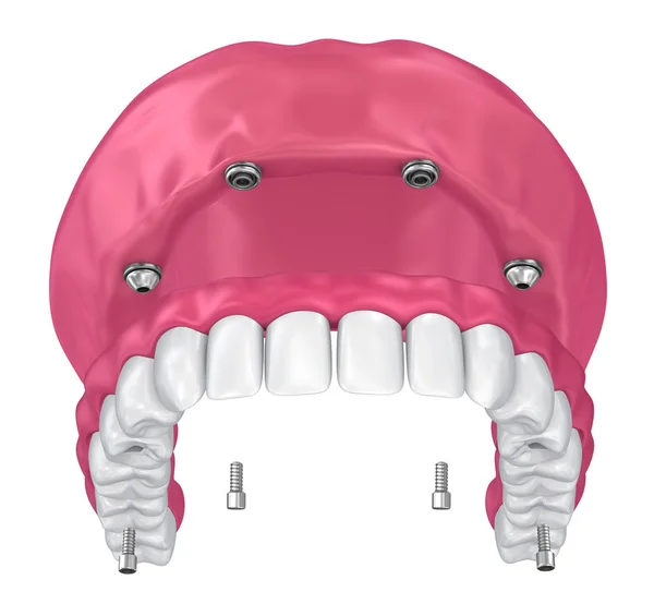 Overdenture Seated Implants Attachments Illustration — Stock Photo, Image