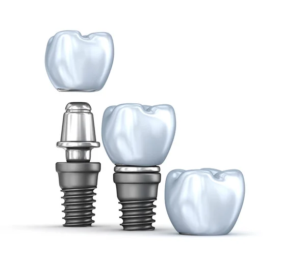 Зубні Імплантати Набір Ізольованих Білому Тлі Ілюстрація — стокове фото
