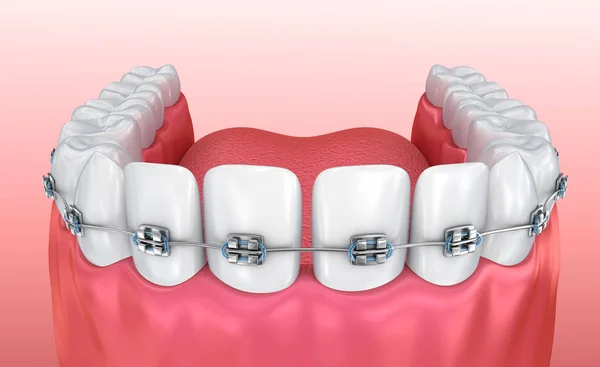Zęby Szelkami Białym Tle Medycznie Dokładne Ilustracja — Zdjęcie stockowe