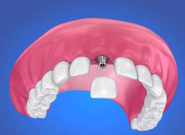Implante Dentário Processo Instalação Coroa Ilustração Medicamente Precisa — Fotografia de Stock