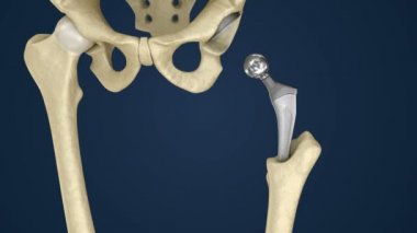 Kalça protezi implant leğen kemiği yüklü. Tıbben doğru 3d animasyon