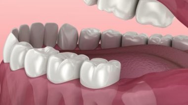 Yirmilik diş sorunu. Tıbben doğru diş 3d animasyon