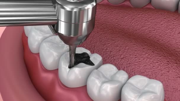 Odstranění Kazu Trhlina Zubní Výplně Lékařsky Přesný Obrázek — Stock video