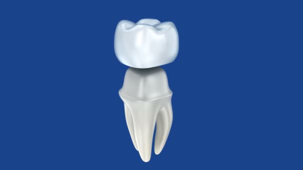 Dental crowns and tooth, 3d Concept animation