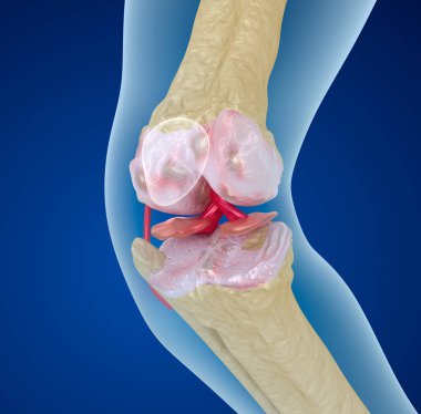 Diz eklem, tıbben doğru 3d çizim Osteoporozu 