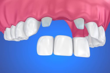 Desteklenen sabit köprü diş. Tıbben doğru 3d çizim