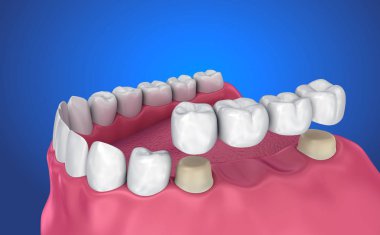Desteklenen sabit köprü diş. Tıbben doğru 3d çizim