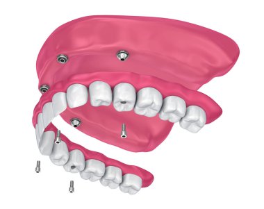 Overdenture üzerinde oturmak için ekleri implantları. 3D çizim