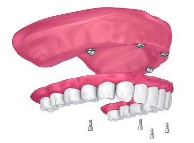 Overdenture üzerinde oturmak için ekleri implantları. 3D çizim