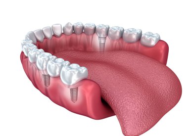 Alt dişler ve diş implantı şeffaf izole üzerinde beyaz render. 3D çizim