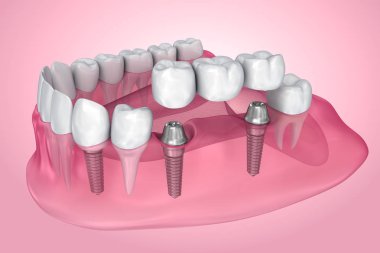 Desteklenen sabit köprü implant. Saydam görünümü. Tıbben doğru 3d çizim