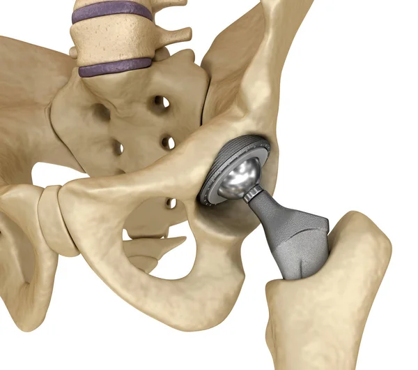Implante Reemplazo Cadera Instalado Hueso Pelvis Ilustración Médicamente Precisa — Foto de Stock