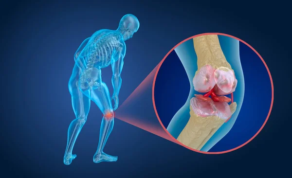 膝の関節 医学的に正確な イラストレーションの骨粗鬆症 — ストック写真