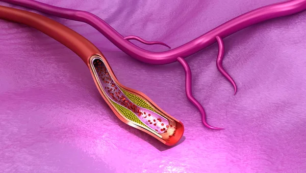 血管は 医学的に正確な イラストでプラークのコレステロール — ストック写真