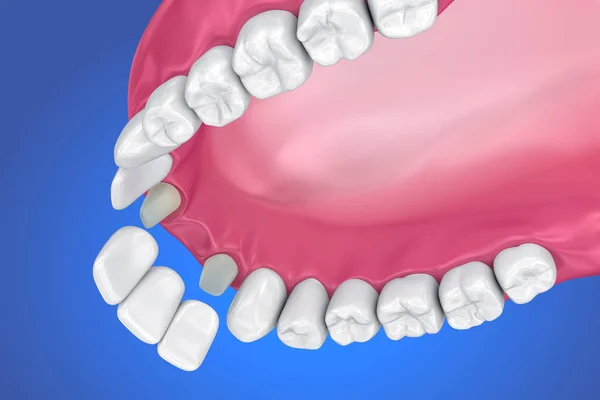 Dente Suportado Ponte Fixa Ilustração Medicamente Precisa — Fotografia de Stock