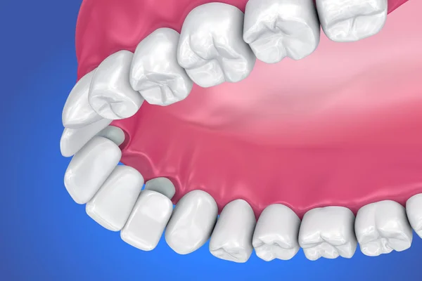 Zębów Obsługiwane Stałego Mostu Medycznie Dokładne Ilustracja — Zdjęcie stockowe