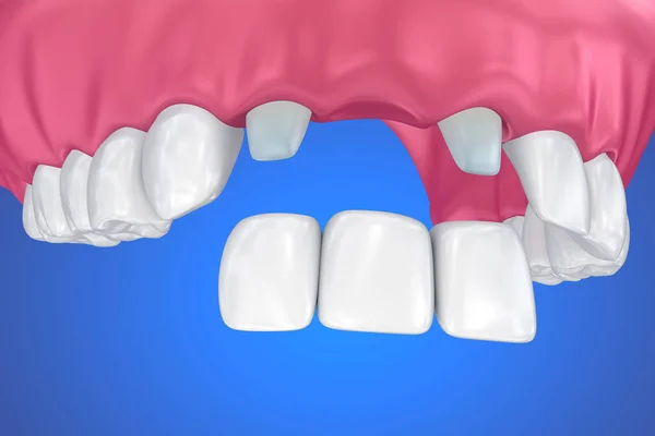 Zahngestützte Feste Brücke Medizinisch Korrekte Illustration — Stockfoto