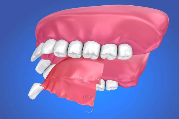 Dent Manquante Unique Prothèse Partielle Amovible Illustration — Photo
