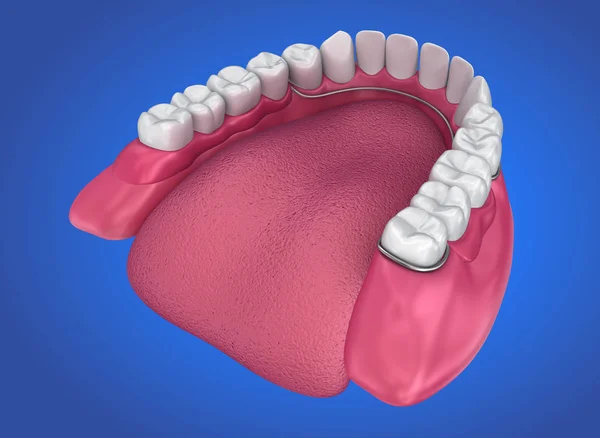 Dentadura Parcial Removível Ilustração Medicamente Precisa — Fotografia de Stock