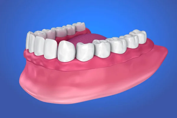 Toutes Les Dents Manquantes Prothèse Complète Amovible Illustration — Photo