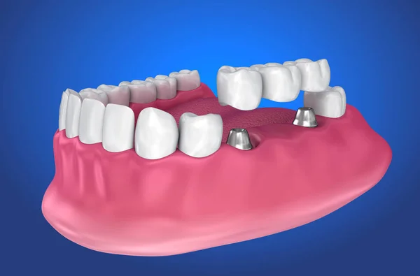 Implantátumok Rögzülő Rögzített Híd Orvosilag Pontos Illusztráció — Stock Fotó