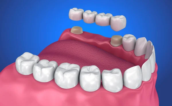 Tooth supported fixed bridge. Medically accurate 3D illustration