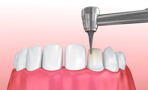 Dental Veneers: Porcelain Veneer installation Procedure. 3D illustration