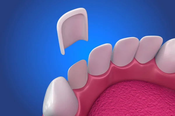 Dental Veneers: Porcelain Veneer installation Procedure. 3D illustration