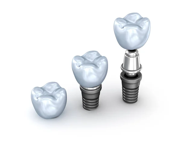 Implantes Dentales Aislados Sobre Fondo Blanco Ilustración —  Fotos de Stock